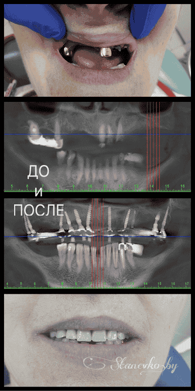 Одноэтапная базальная имплантация зубов