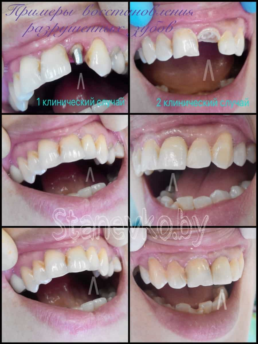Пример работы: Протезирование сломанного переднего зуба