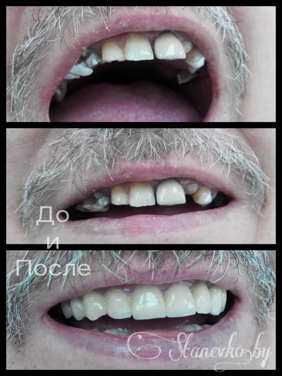 Пример работы: Протезирование циркониевыми коронками